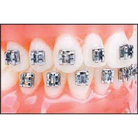 Ortho Arch – 022 Mini Edgewise vs Double Lower Anterriors