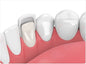 Veneers - 1