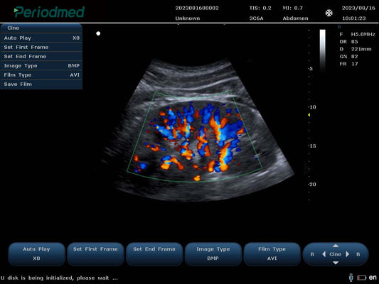 Color Doppler Ultrasound 15 inch with Convex probe for advanced imaging in hospitals and clinics in UAE