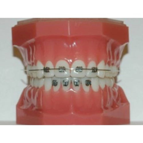 Ortho Arch – 022 Mini Edgewise Vs Double Upper Lateral