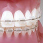 Ortho Arch – UR/LL Conlin Light Wire Composite Brackets Central Lateral