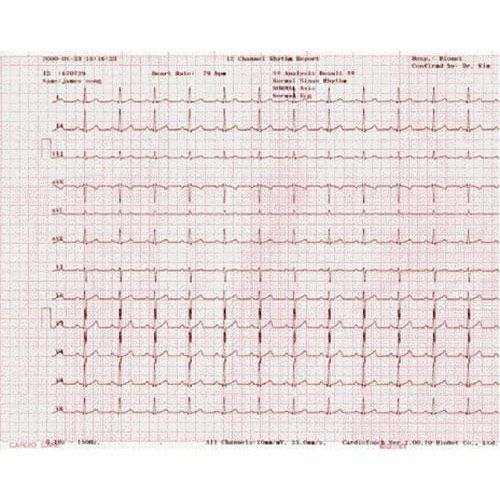 صحيفة تليجراف الماليزية – ورق تخطيط القلب الكهربائي Bionet Cardiocare 2000/3000 (مع رسم بياني) (CSO)