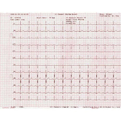 صحيفة تليجراف الماليزية – ورق تخطيط القلب الكهربائي Bionet Cardiocare 2000/3000 (مع رسم بياني) (CSO)